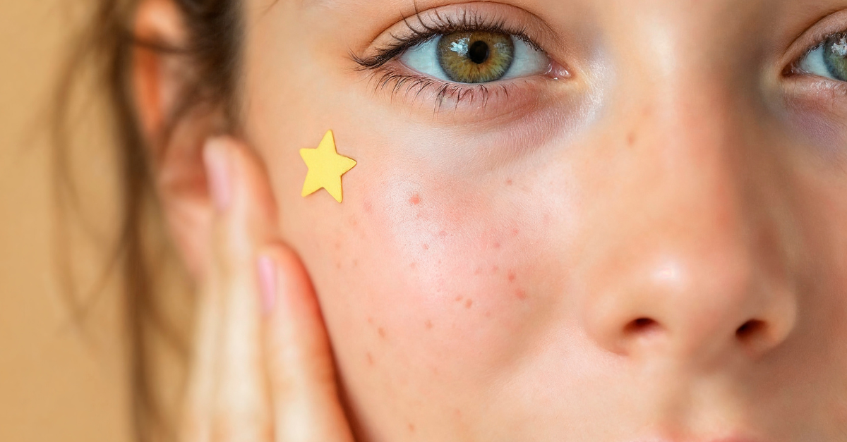 O adesivo que transformou acnes em acessórios e gerou um negócio de mais de US$90 milhões